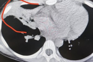 「沈阳肺炎病例」〃沈阳肺炎病例最新消息