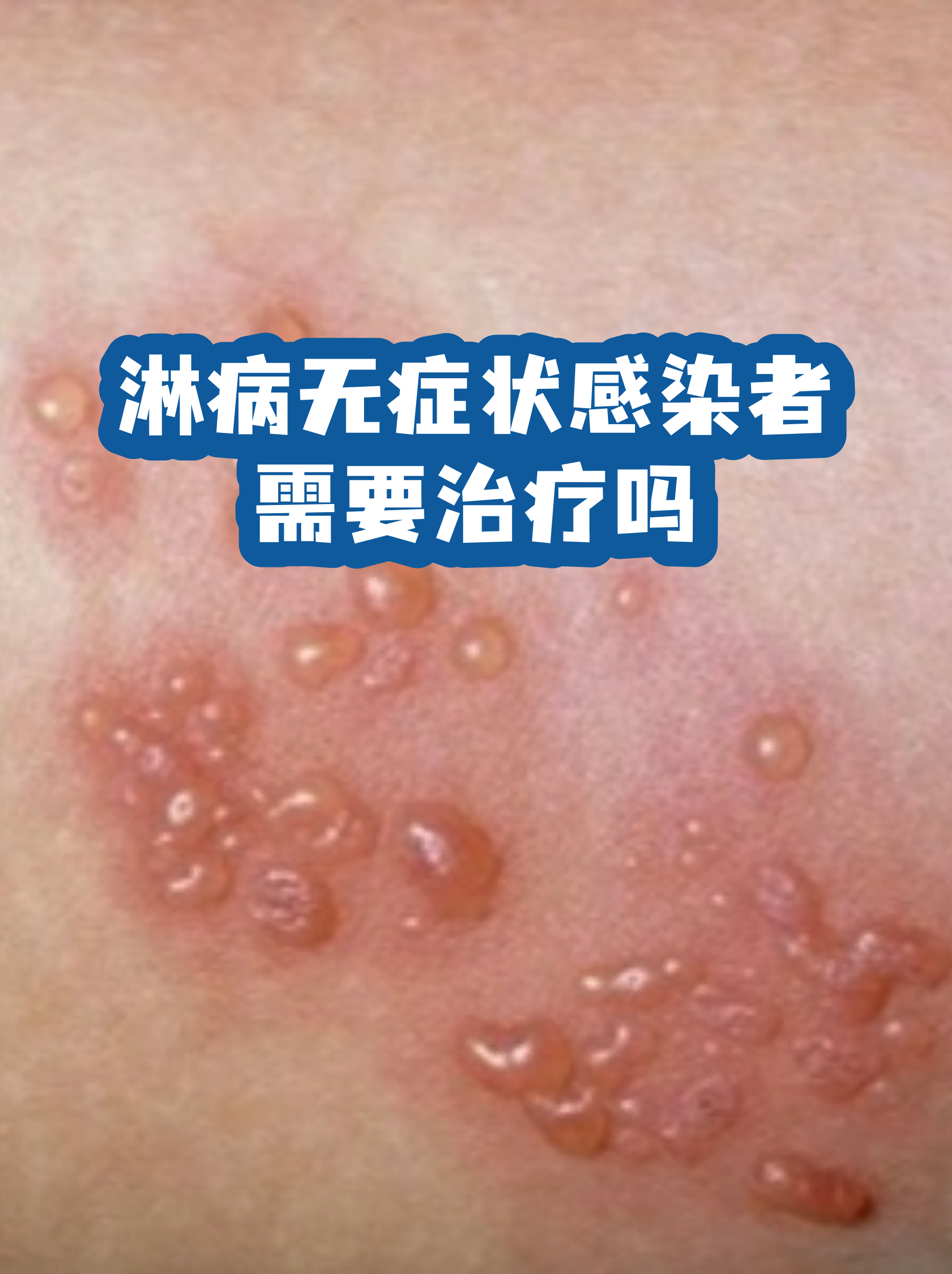 31省区市新增无症状感染12例.31省新增本土无症状感染者2例-第2张图片