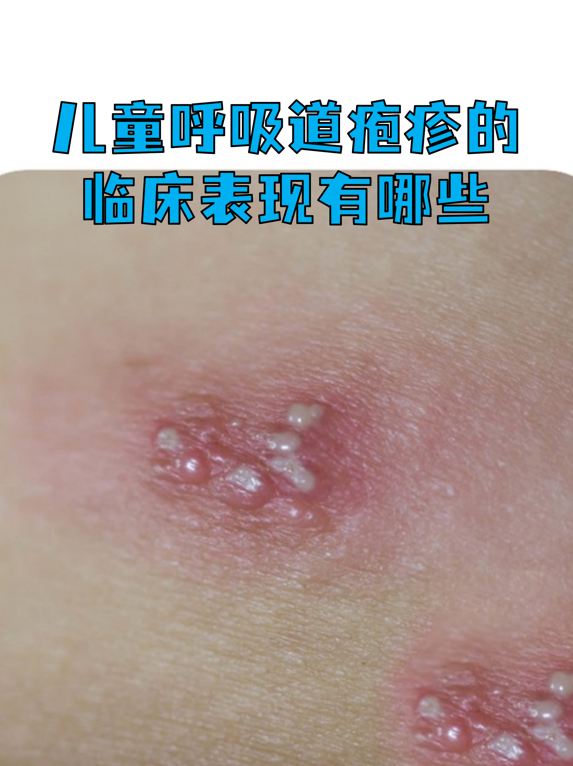 感染进度-感染过程的五大表现-第1张图片
